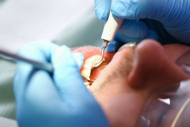 Best Knocked-Out Tooth Emergency  in Fort Mckinley, OH